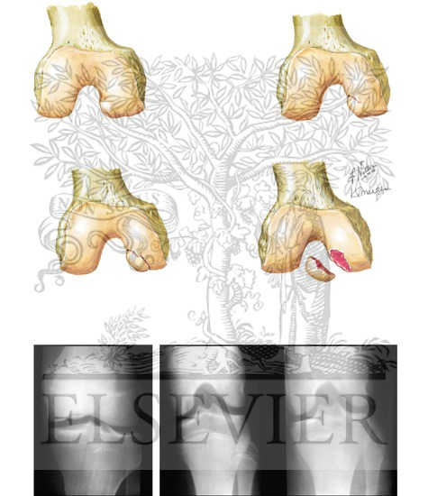 Progression of Osteochondritis Dissecans