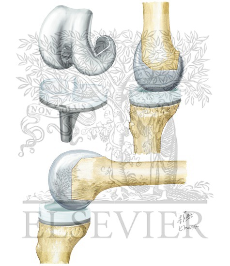 Watermarked preview of unlabeled image: Knee Arthroplasty: Posterior Stabilized Knee Prosthesis