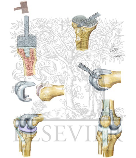 Watermarked preview of unlabeled image: Total Knee Replacement Technique: Steps 15 to 20