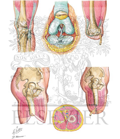 Disarticulation of Knee and Above-Knee Amputation