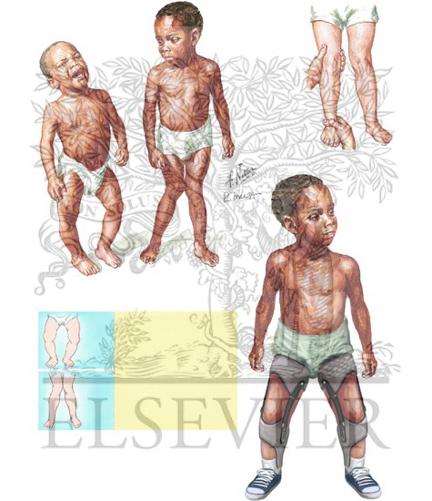 Bowleg and Knock-Knee