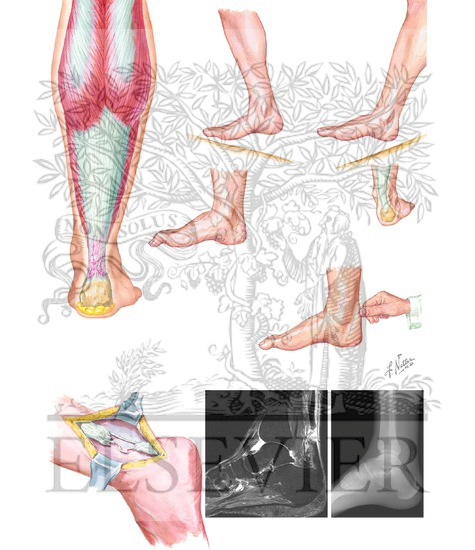 Achilles Tendon Rupture