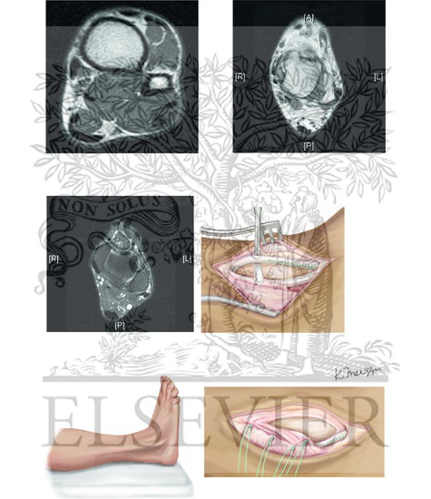 Peroneal Tendon Injury