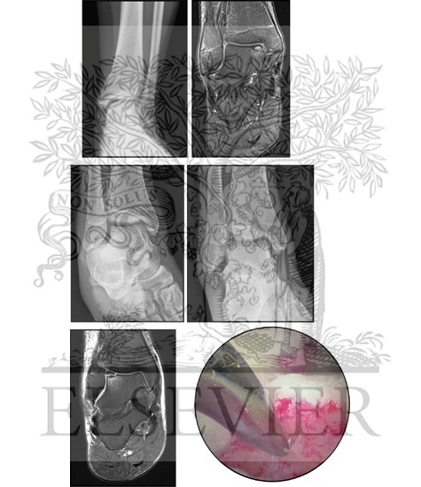 Osteochondral Lesions of the Talus
