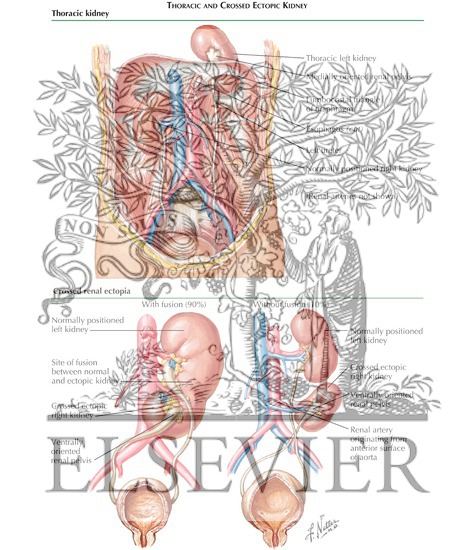 Watermarked preview of labeled image: Renal Ascent and Ectopia: Thoracic and Crossed Ectopic Kidney