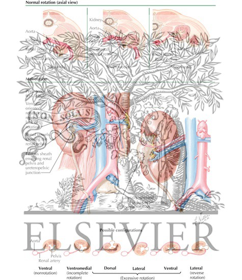 Renal Rotation and Malrotation