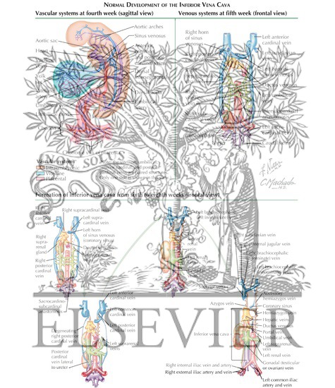 Retrocaval Ureter: Normal Development of the Inferior Vena Cava