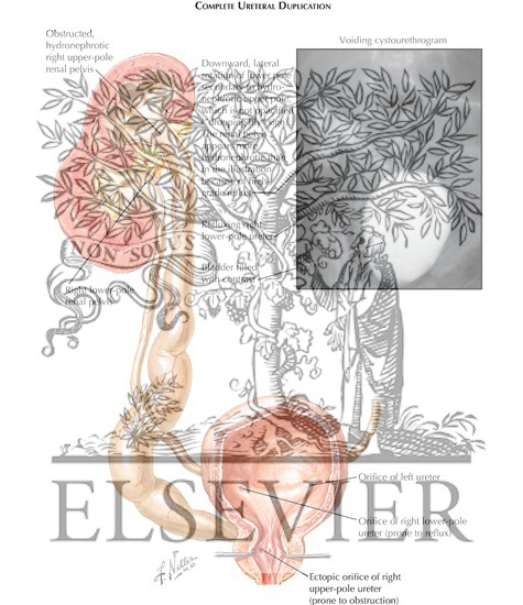 Watermarked preview of labeled image: Ureteral Duplication: Complete