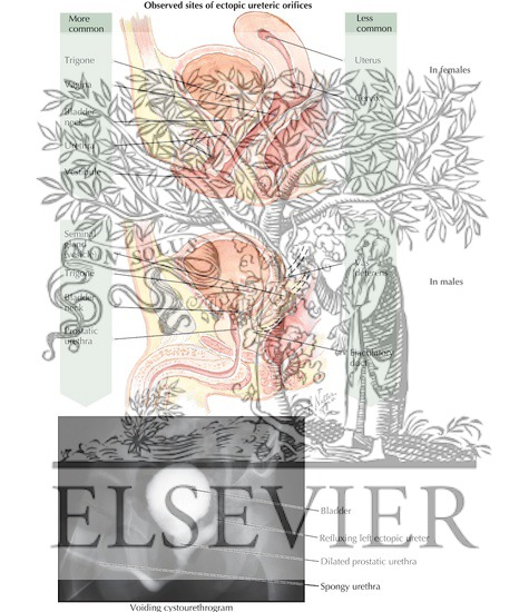 Watermarked preview of labeled image: Ectopic Ureter