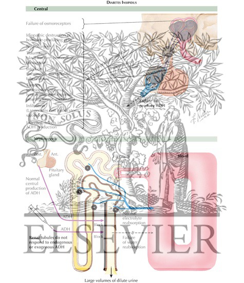 Watermarked preview of labeled image: Nephrogenic Diabetes Insipidus