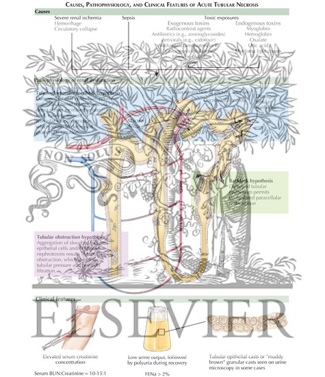Watermarked preview of labeled image: Acute Tubular Necrosis: Causes, Pathophysiology, and Clinical Features