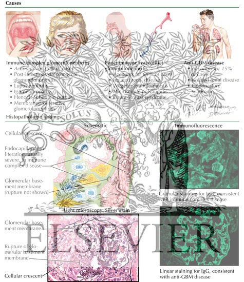 Rapidly Progressive Glomerulonephritis