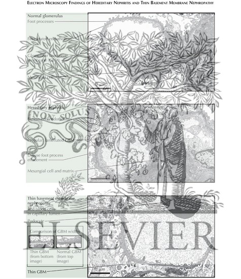 Watermarked preview of labeled image: Hereditary Nephritis (Alport Syndrome)/Thin Basement Membrane Nephropathy: Electron Microscopy Findings