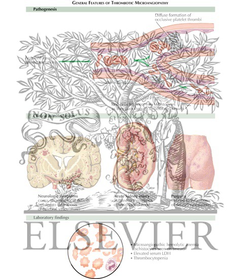 Watermarked preview of labeled image: Thrombotic Microangiopathy: General Features