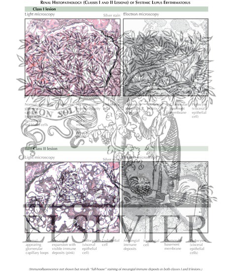 Lupus Nephritis: Renal Histopathology (Classes I and II Lesions)