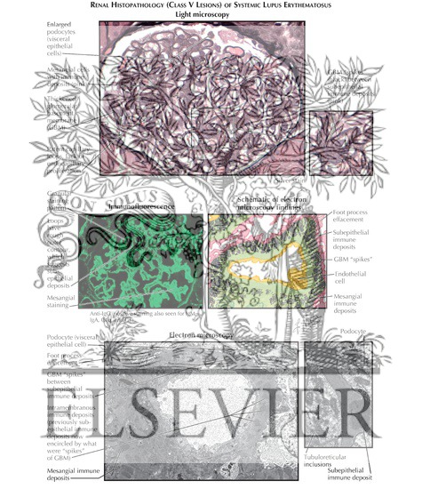 Watermarked preview of labeled image: Lupus Nephritis: Renal Histopathology (Class V Lesions)