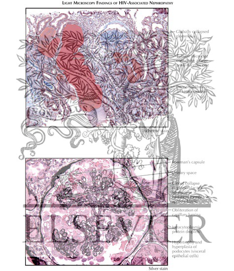 Watermarked preview of labeled image: HIV-Associated Nephropathy: Light Microscopy Findings