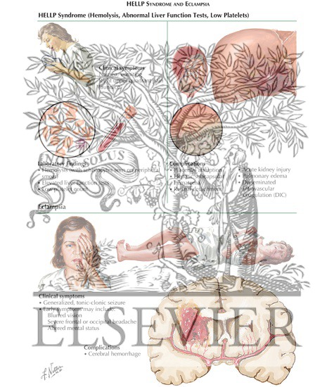 Watermarked preview of labeled image: Preeclampsia: HELLP Syndrome and Eclampsia