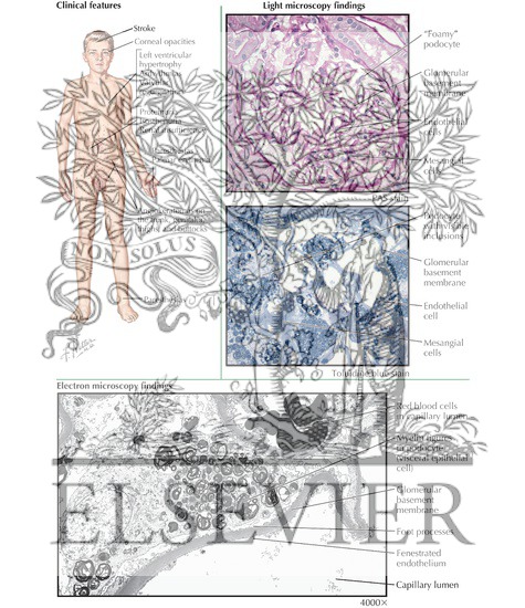 Watermarked preview of labeled image: Fabry Disease