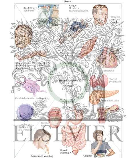 Watermarked preview of labeled image: Overview of Chronic Kidney Disease: Uremia