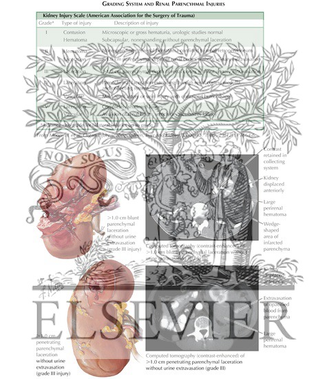 Watermarked preview of labeled image: Renal Injuries: Grading System and Renal Parenchymal Injuries