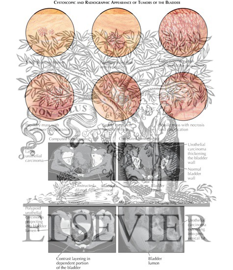 Watermarked preview of labeled image: Tumors of the Bladder: Cystoscopic and Radiographic Appearance