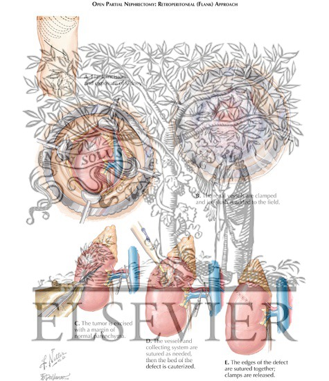 Watermarked preview of labeled image: Partial Nephrectomy: Open Partial Nephrectomy (Retroperitoneal [Flank] Approach)