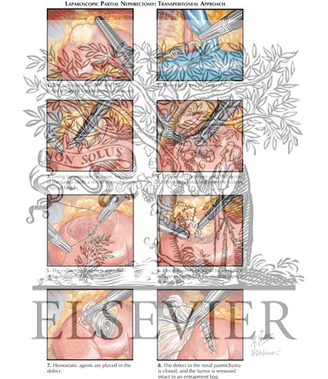 Watermarked preview of labeled image: Partial Nephrectomy: Laparoscopic Partial Nephrectomy (Transperitoneal Approach)