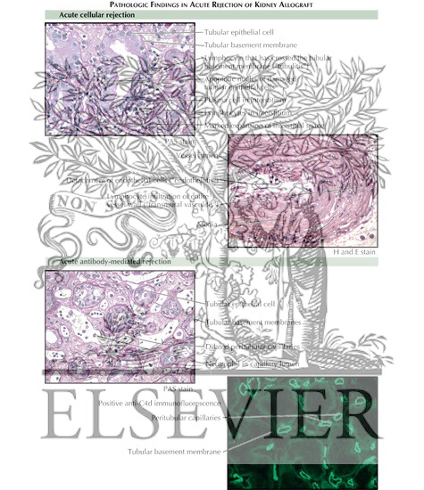 Watermarked preview of labeled image: Renal Transplantation: Acute Rejection (Pathologic Findings)
