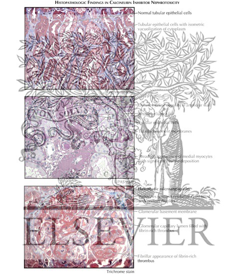 Watermarked preview of labeled image: Renal Transplantation: Calcineurin Inhibitor Nephrotoxicity (Histopathologic Findings)