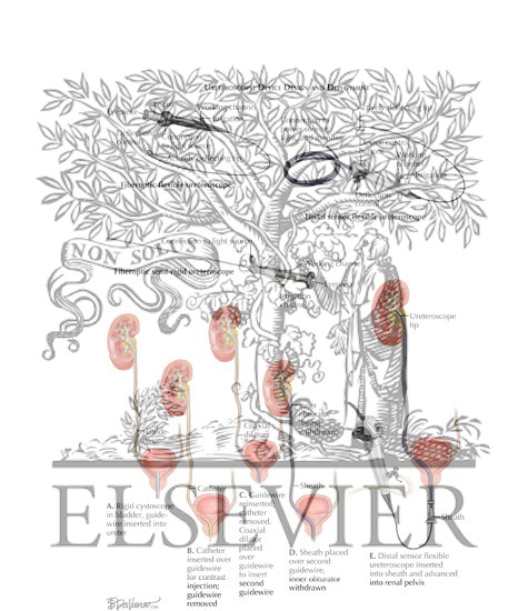 Watermarked preview of labeled image: Ureteroscopy: Device Design and Deployment