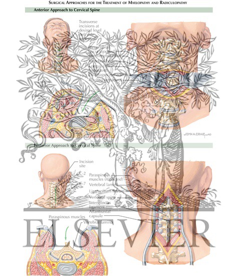 Watermarked preview of labeled image: Anterior Approach to Cervical Spine