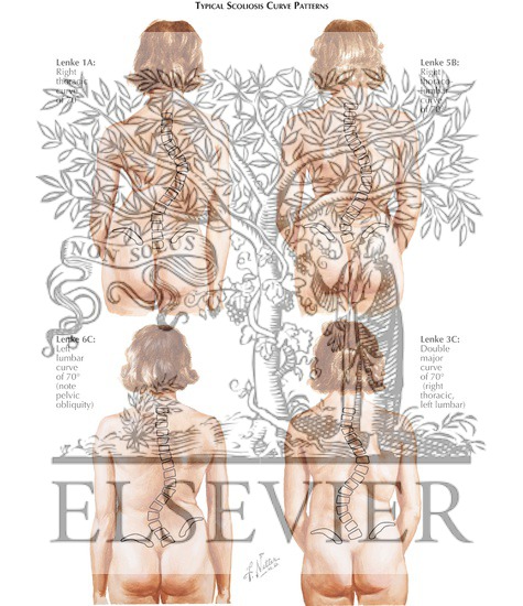 Watermarked preview of labeled image: Scoliosis Curve Patterns