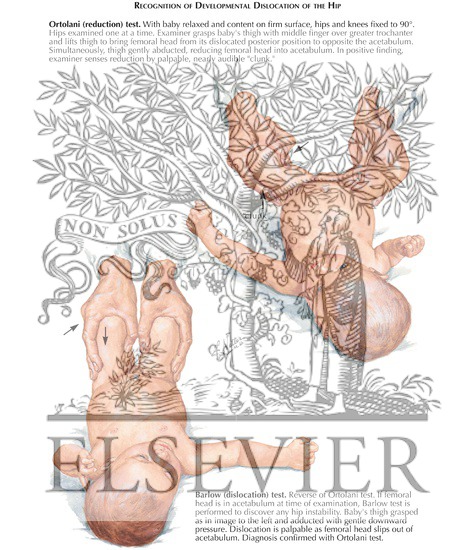 Watermarked preview of labeled image: Recognition of Congenital Dislocation of the Hip