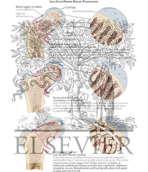 Watermarked preview of labeled image: Pathogenesis of Legg - Calve - Perthes Disease
