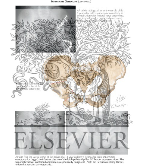 Watermarked preview of labeled image: Innominate Osteotomy (Continued)