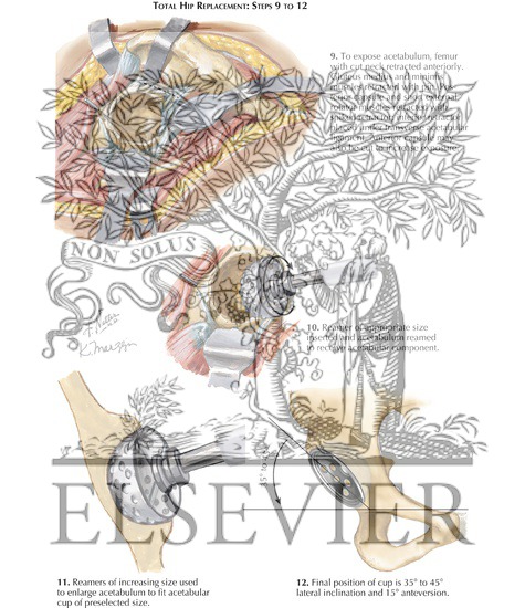 Watermarked preview of labeled image: Technique for Total Hip Replacement