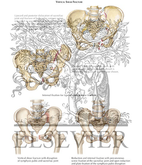 Injury to Pelvis: Vertical Shear Fracture