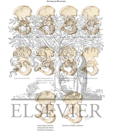 Watermarked preview of labeled image: Acetabular Fractures