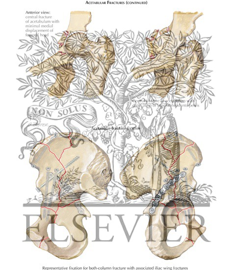 Watermarked preview of labeled image: Injury to Hip: Acetabular Fractures (Continued)