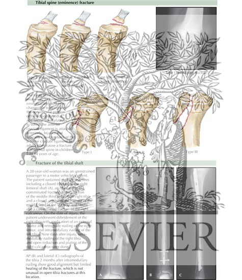 Fracture of Tibial Tubercle, Tibial Spine, and Tibial Shaft