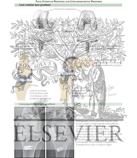 Watermarked preview of labeled image: Knee Arthroplasty: Total Condylar Prosthesis and Unicompartmental Prosthesis