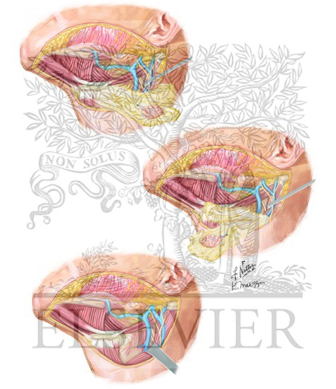 Dissection of Levels II (Upper Jugular Modal Chain) and III (Midjugular Nodal Chain)