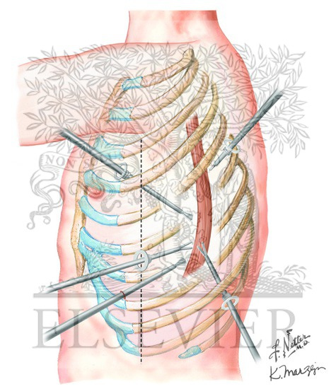 Ivor Lewis Esophagectomy: Five-Port Laparascopic Placement