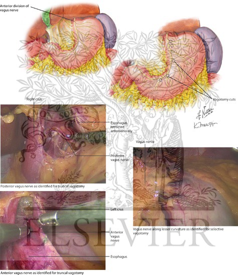 Truncal and Highly Selective Vagotomies