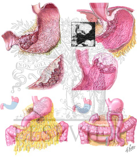 Distal and Proximal Gastric Cancer and Reconstruction