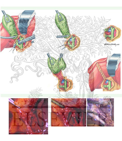 Watermarked preview of unlabeled image: Cholecystectomy and the Critical View