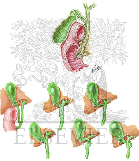 Cystic Duct Anatomy and Variants