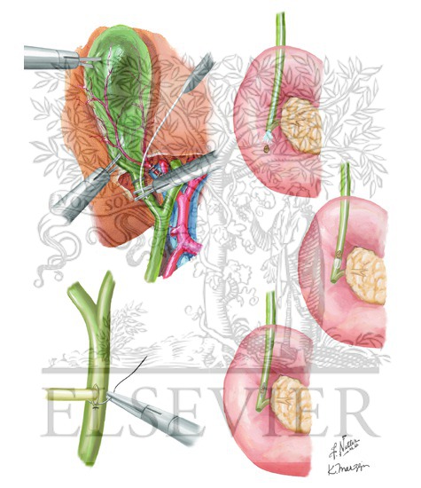 Watermarked preview of unlabeled image: Transystic and Transductal/Choledochotomy Approaches