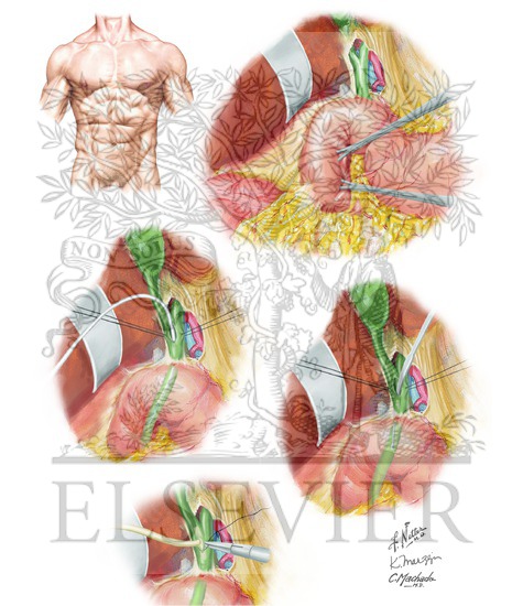 Open Common Bile Duct Exploration